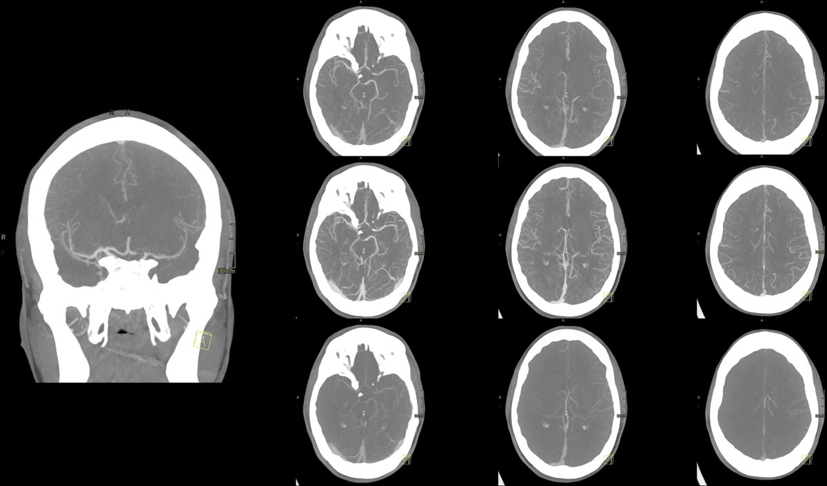 ica-m1-intracranial-dissection-evt-figure2