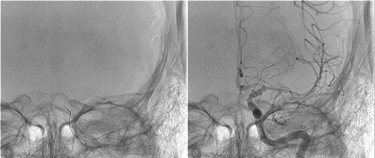 ica-m1-intracranial-dissection-evt-figure20