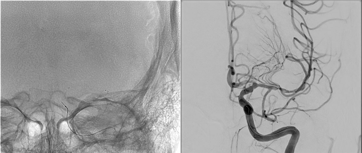 ica-m1-intracranial-dissection-evt-figure20