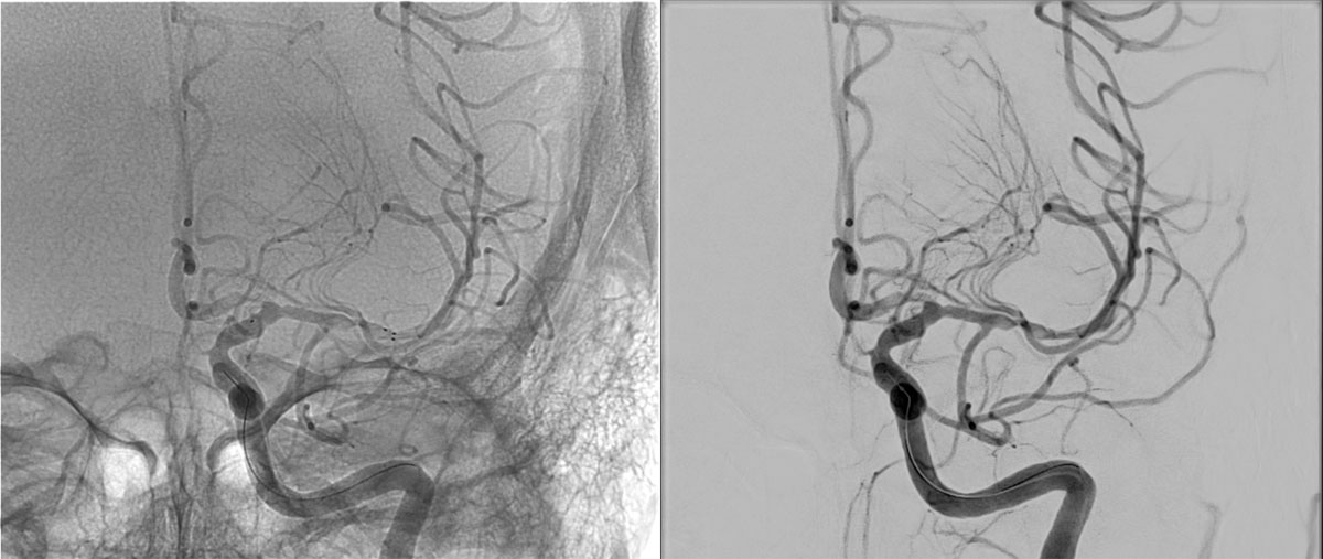 ica-m1-intracranial-dissection-evt-figure21