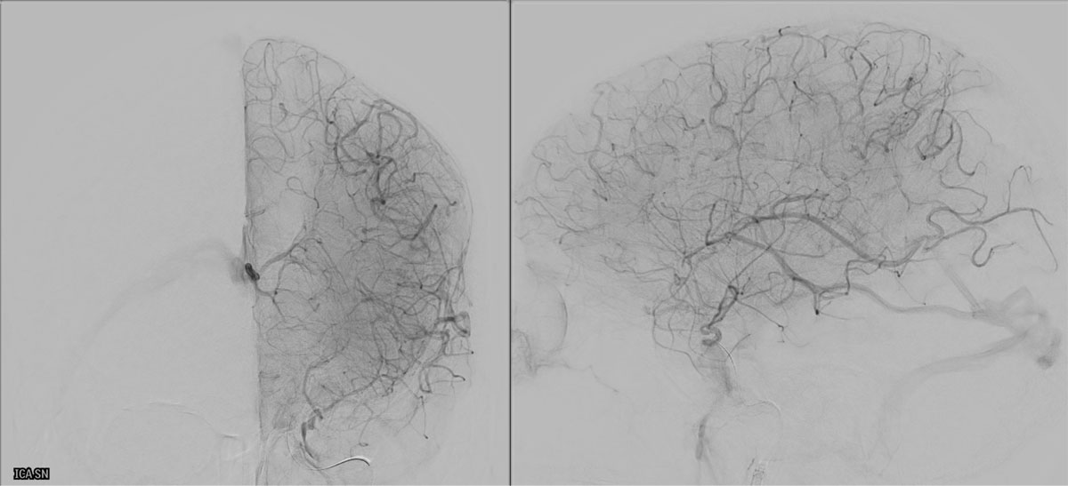 ica-m1-intracranial-dissection-evt-figure22