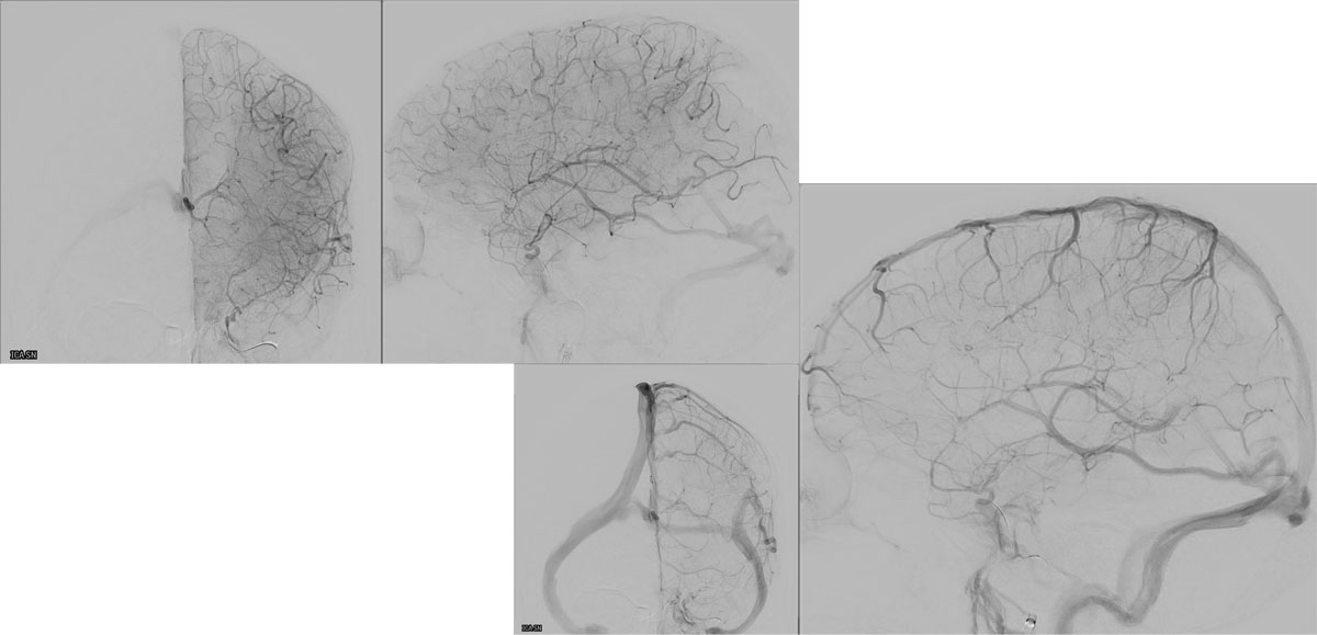 ica-m1-intracranial-dissection-evt-figure23