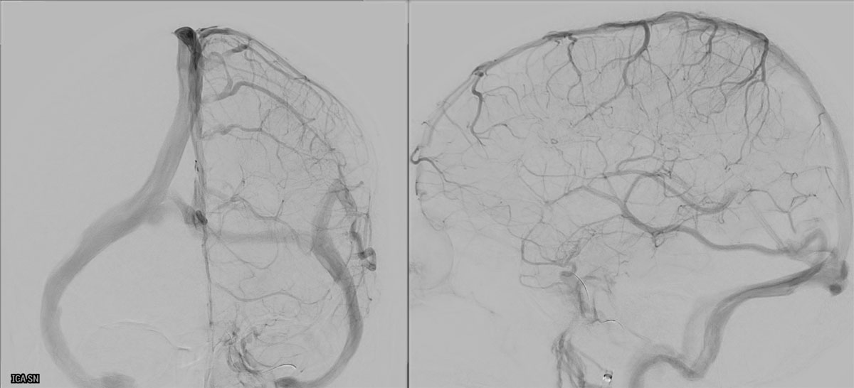 ica-m1-intracranial-dissection-evt-figure23
