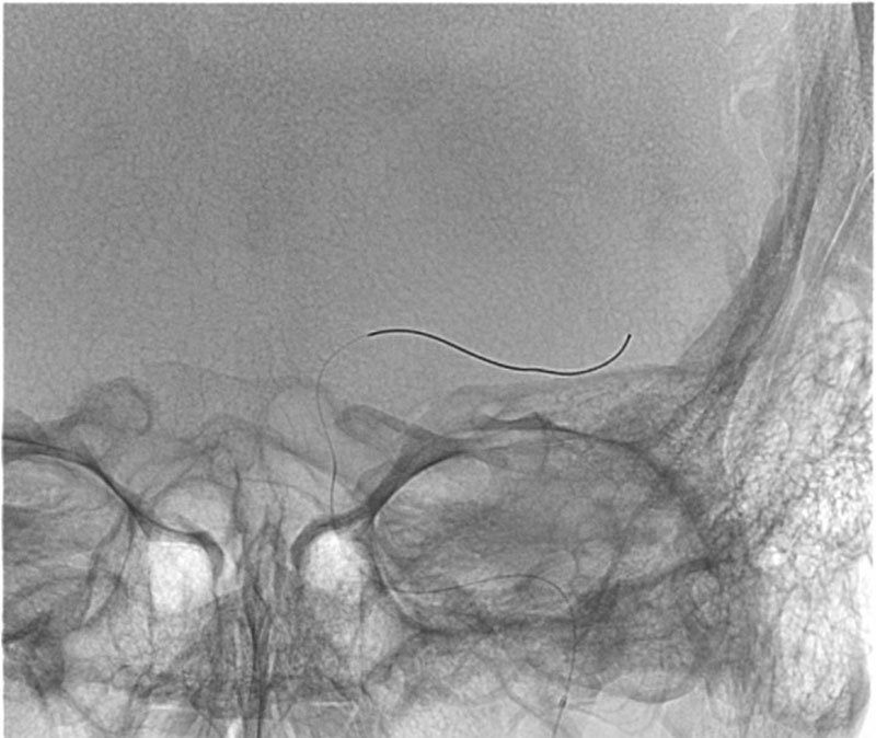 ica-m1-intracranial-dissection-evt-figure24