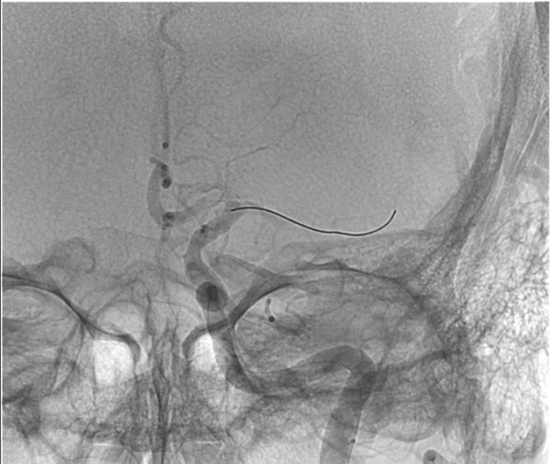 ica-m1-intracranial-dissection-evt-figure25