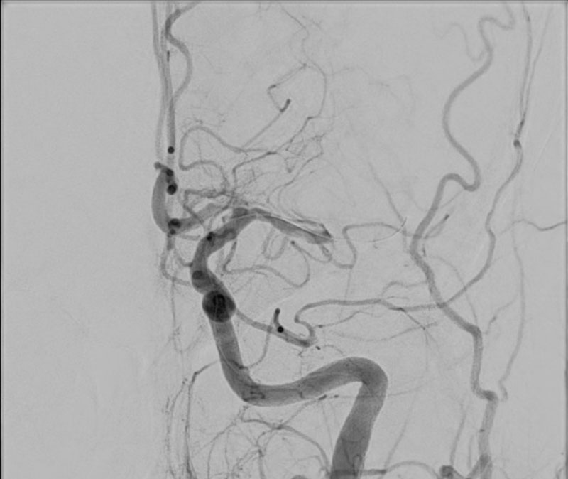 ica-m1-intracranial-dissection-evt-figure26