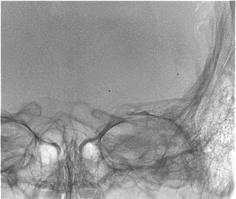 ica-m1-intracranial-dissection-evt-figure27