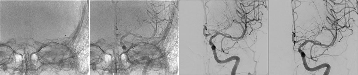 ica-m1-intracranial-dissection-evt-figure28