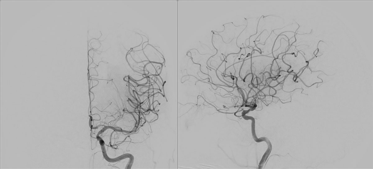 ica-m1-intracranial-dissection-evt-figure29
