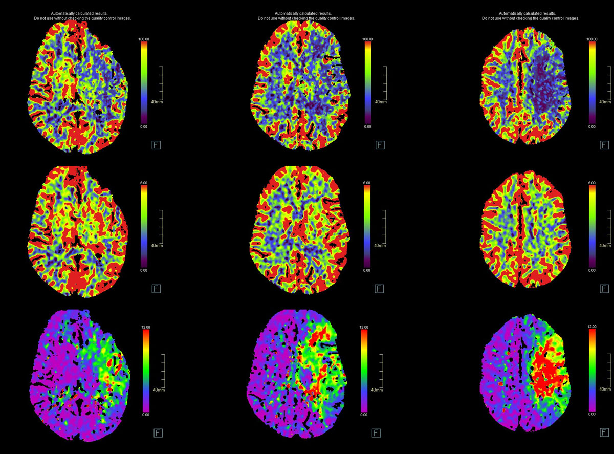 ica-m1-intracranial-dissection-evt-figure3