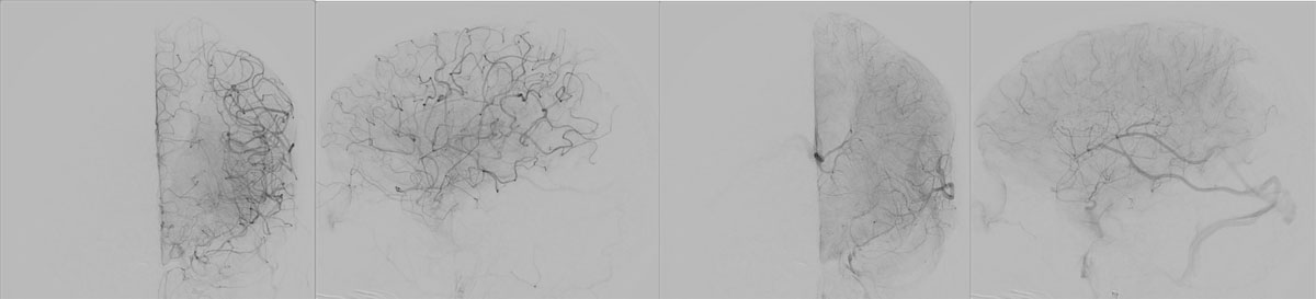 ica-m1-intracranial-dissection-evt-figure30