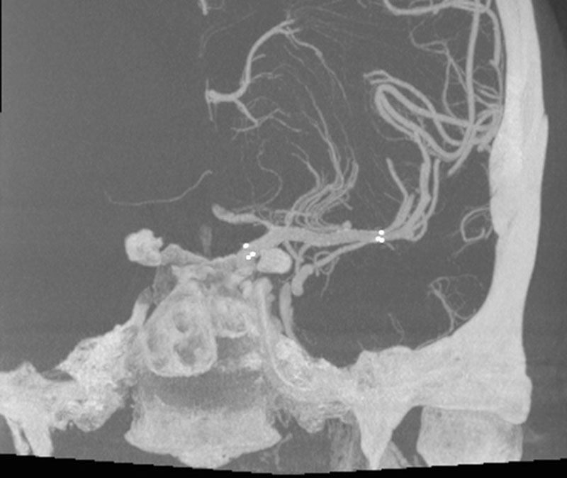 ica-m1-intracranial-dissection-evt-figure31