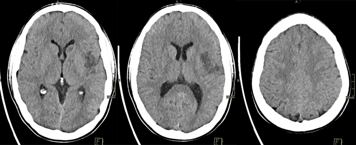 ica-m1-intracranial-dissection-evt-figure32