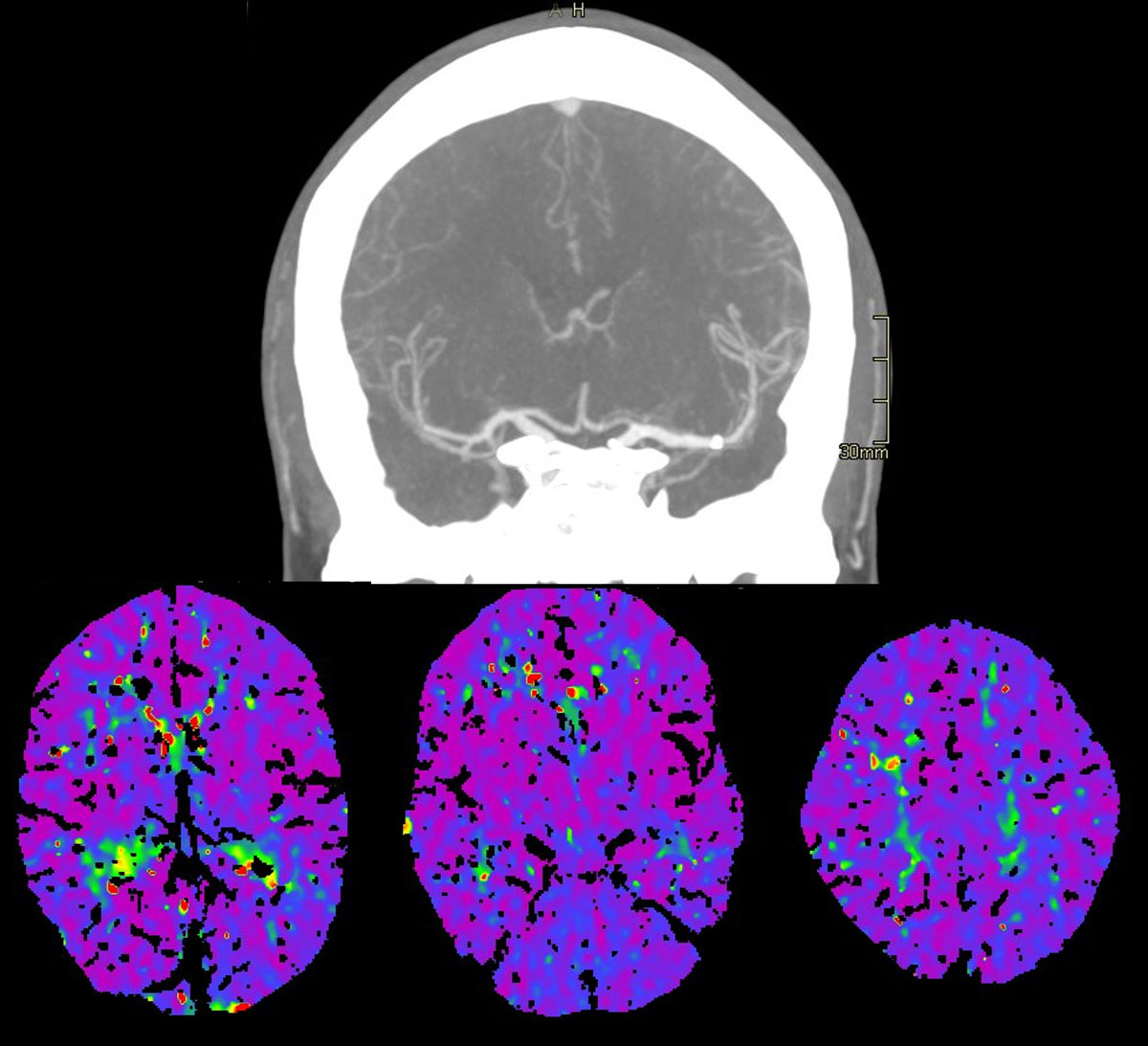 ica-m1-intracranial-dissection-evt-figure33