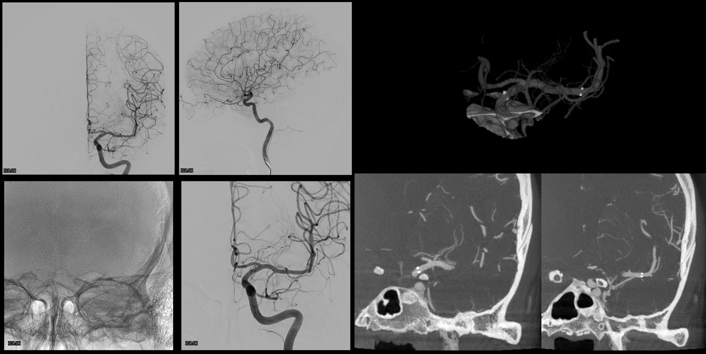 ica-m1-intracranial-dissection-evt-figure34