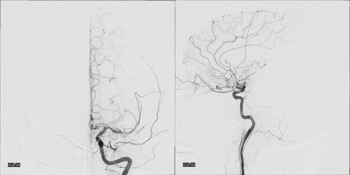 ica-m1-intracranial-dissection-evt-figure4