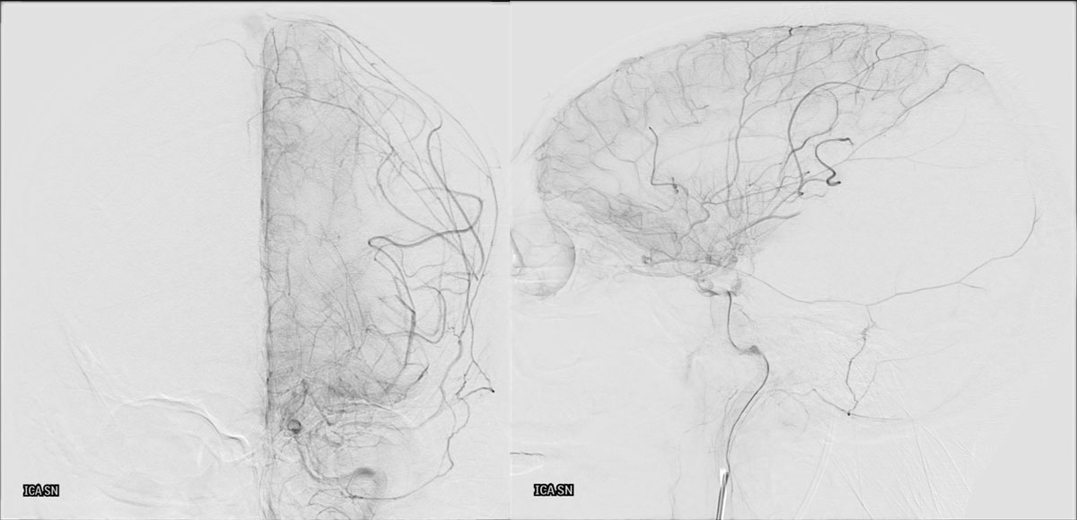 ica-m1-intracranial-dissection-evt-figure5