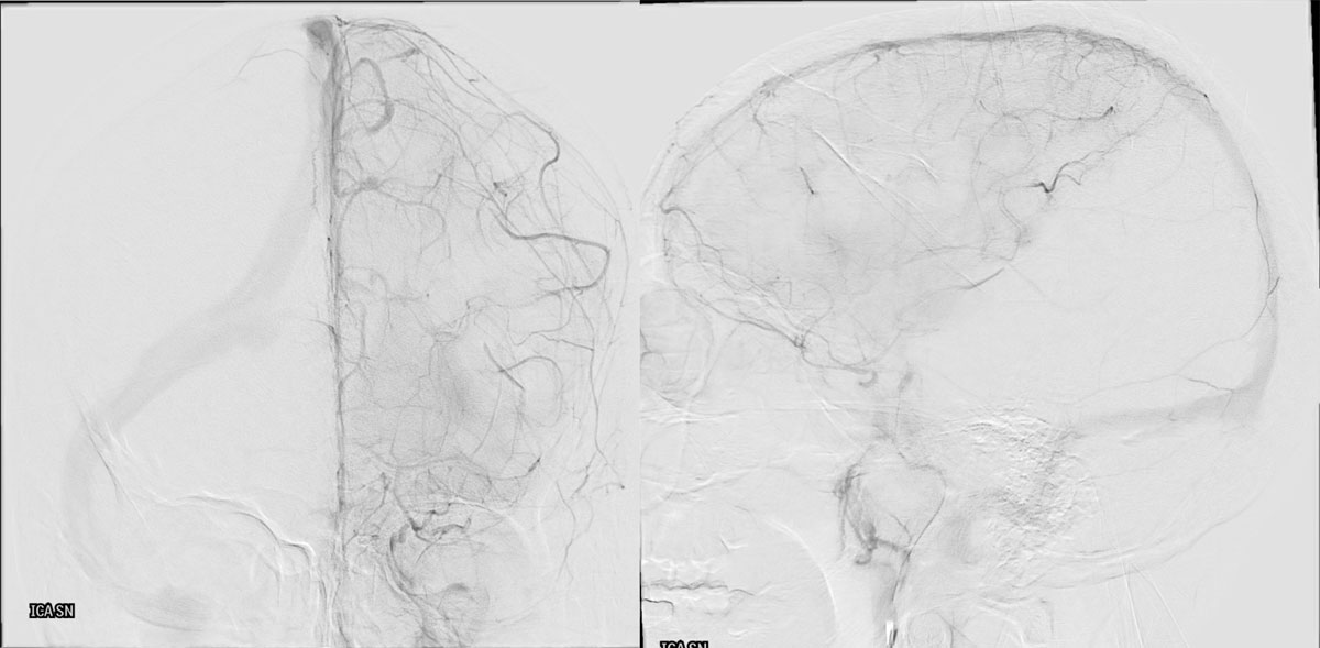 ica-m1-intracranial-dissection-evt-figure6