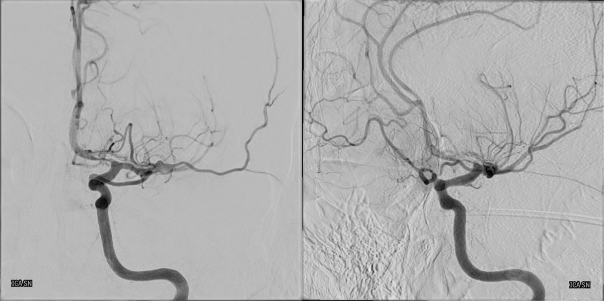 ica-m1-intracranial-dissection-evt-figure7