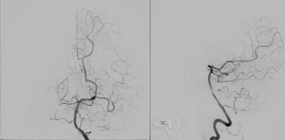 ica-m1-intracranial-dissection-evt-figure8