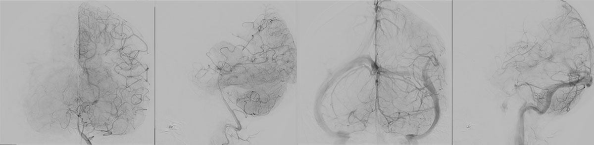 ica-m1-intracranial-dissection-evt-figure9