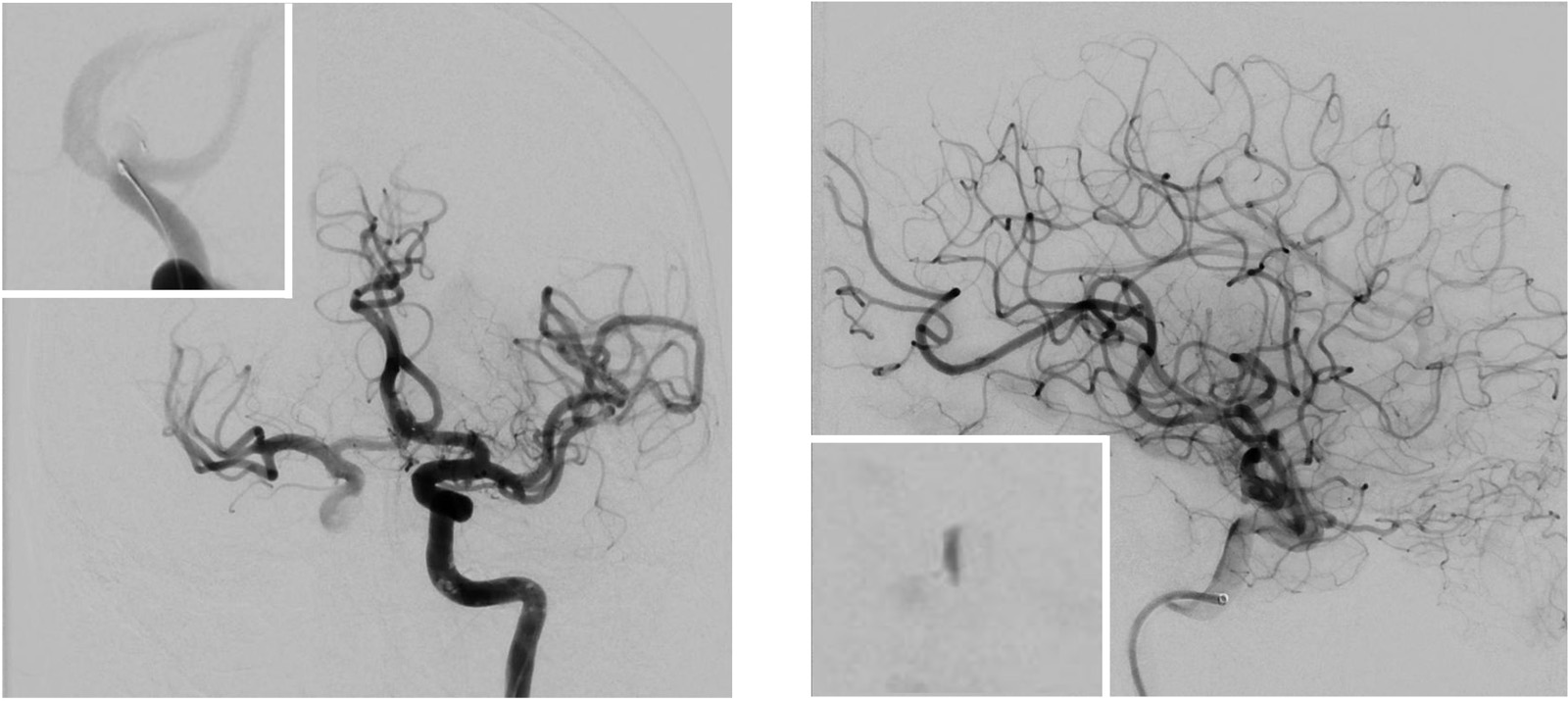 Implantation of an Artisse™ intrasaccular Device for an incidental Acom aneurysm - Figure 10