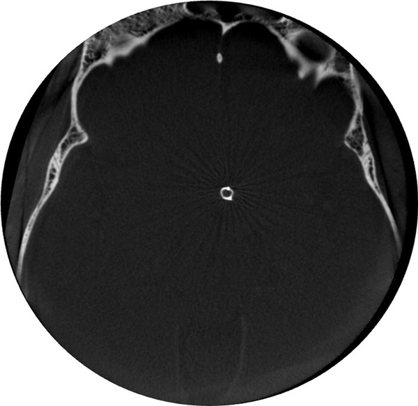 Implantation of an Artisse™ intrasaccular Device for an incidental Acom aneurysm - Figure 11