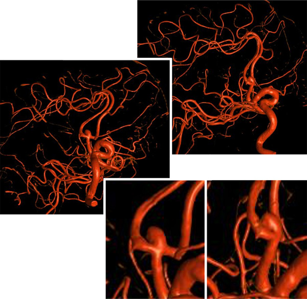 Implantation of an Artisse™ intrasaccular Device for an incidental Acom aneurysm - Figure 3