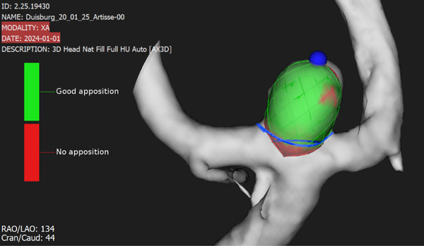 Implantation of an Artisse™ intrasaccular Device for an incidental Acom aneurysm - Figure 4