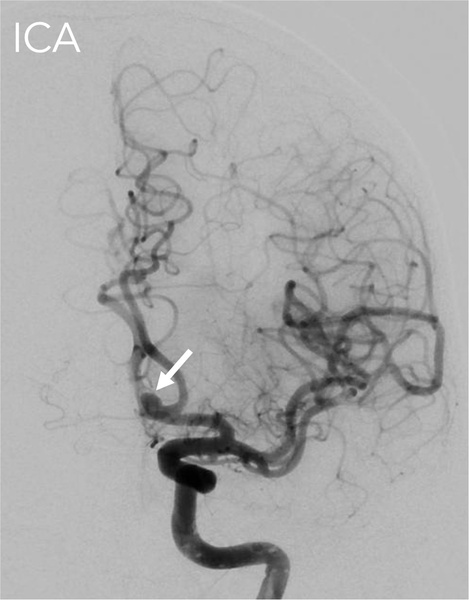 Implantation of an Artisse™ intrasaccular Device for an incidental Acom aneurysm - Figure 6