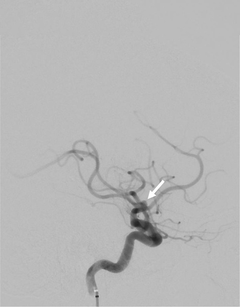 Implantation of an Artisse™ intrasaccular Device for an incidental Acom aneurysm - Figure 7