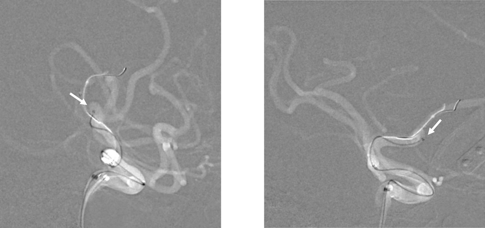 Implantation of an Artisse™ intrasaccular Device for an incidental Acom aneurysm - Figure 9