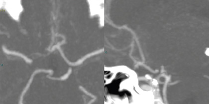 One&Done technique with optiMAX large volume coils: CTA MIP Acom aneurysm
