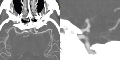 One&Done technique with optiMAX large volume coils: CTA MIP AchoA aneurysm