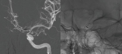 One&Done technique with optiMAX large volume coils: Coiling of the ruptured Acom aneurysm