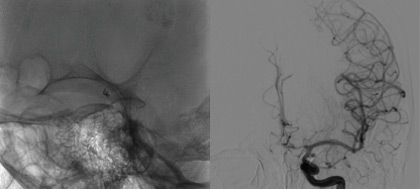 One&Done technique with optiMAX large volume coils: Coiling of the ruptured Acom aneurysm