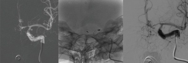 One&Done technique with optiMAX large volume coil: Coiling of the AchoA aneurysm