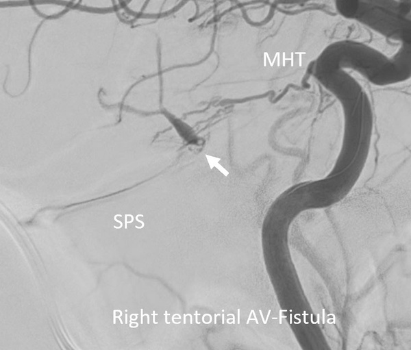 retrograde-transvenous-embolization-of-a-tentorial-dural-av-fistula-figure1