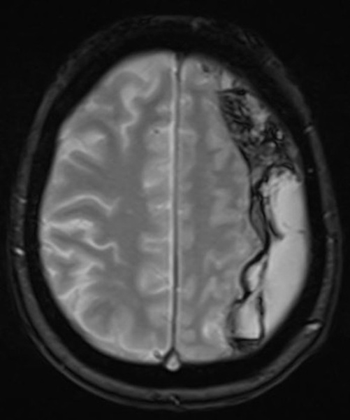 subdural-hematoma-preventing-recurrence-with-a-three-step-onyx-embolization-image1