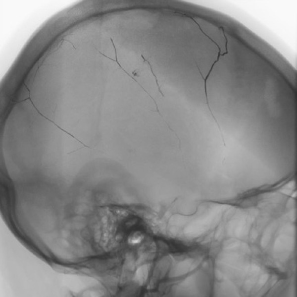subdural-hematoma-preventing-recurrence-with-a-three-step-onyx-embolization-image11