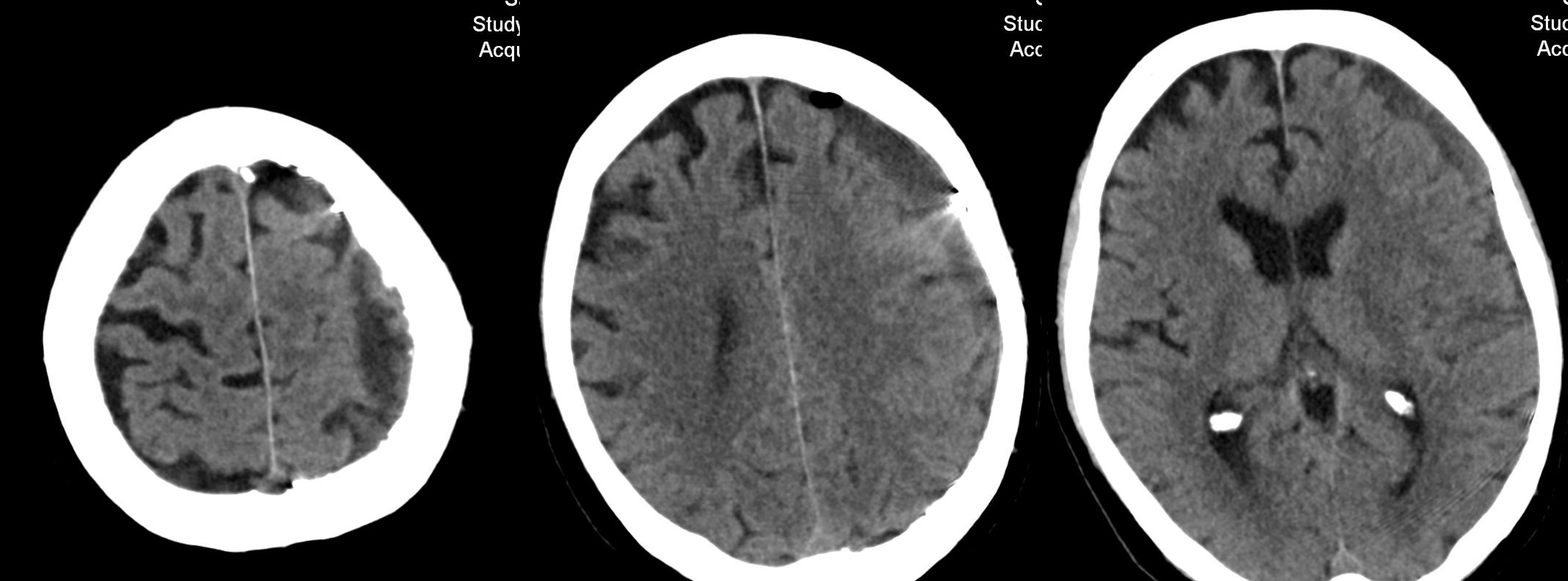 subdural-hematoma-preventing-recurrence-with-a-three-step-onyx-embolization-image12