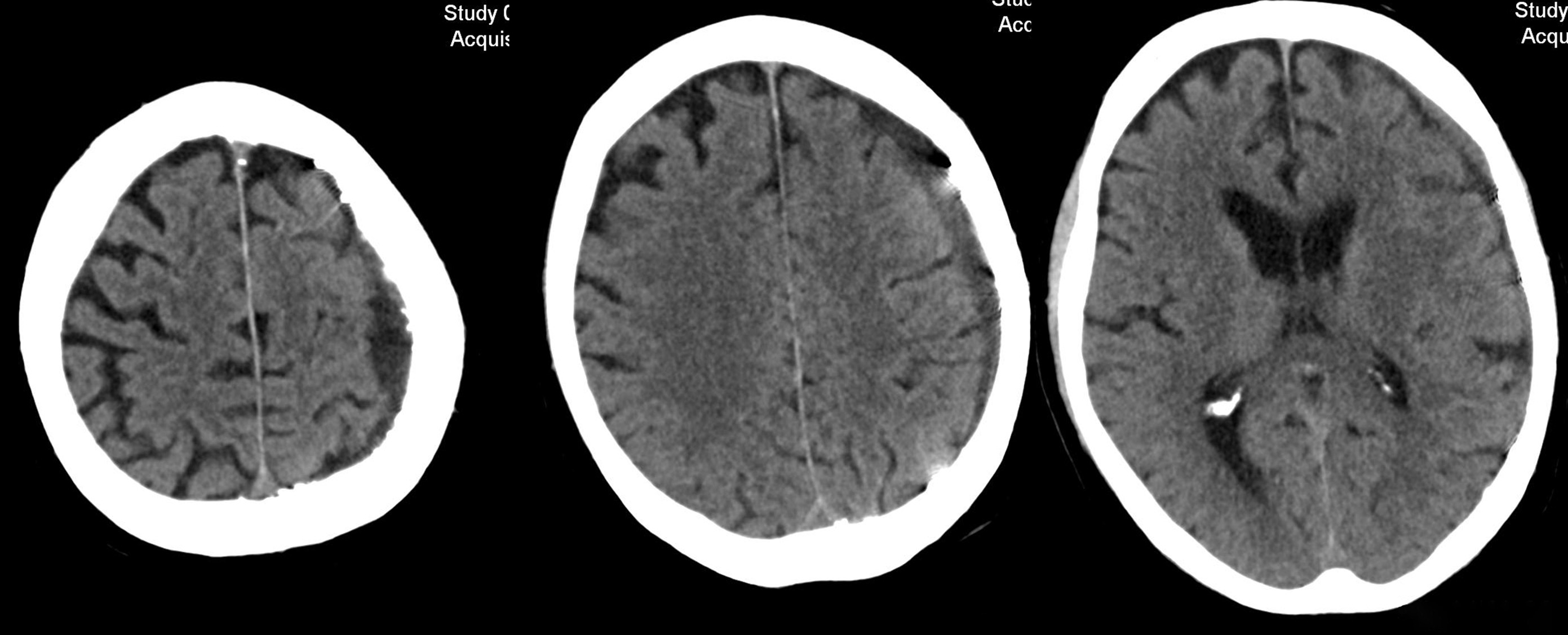 subdural-hematoma-preventing-recurrence-with-a-three-step-onyx-embolization-image13