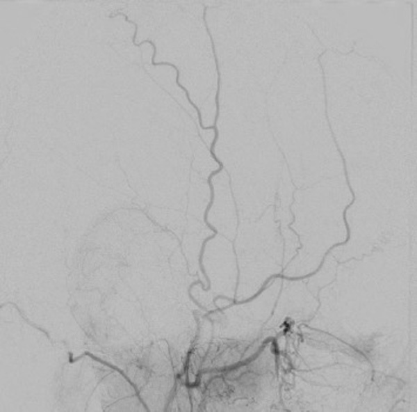 subdural-hematoma-preventing-recurrence-with-a-three-step-onyx-embolization-image3