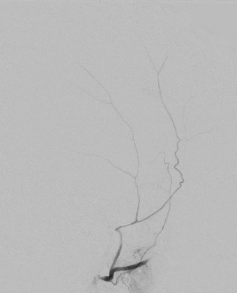 subdural-hematoma-preventing-recurrence-with-a-three-step-onyx-embolization-image4