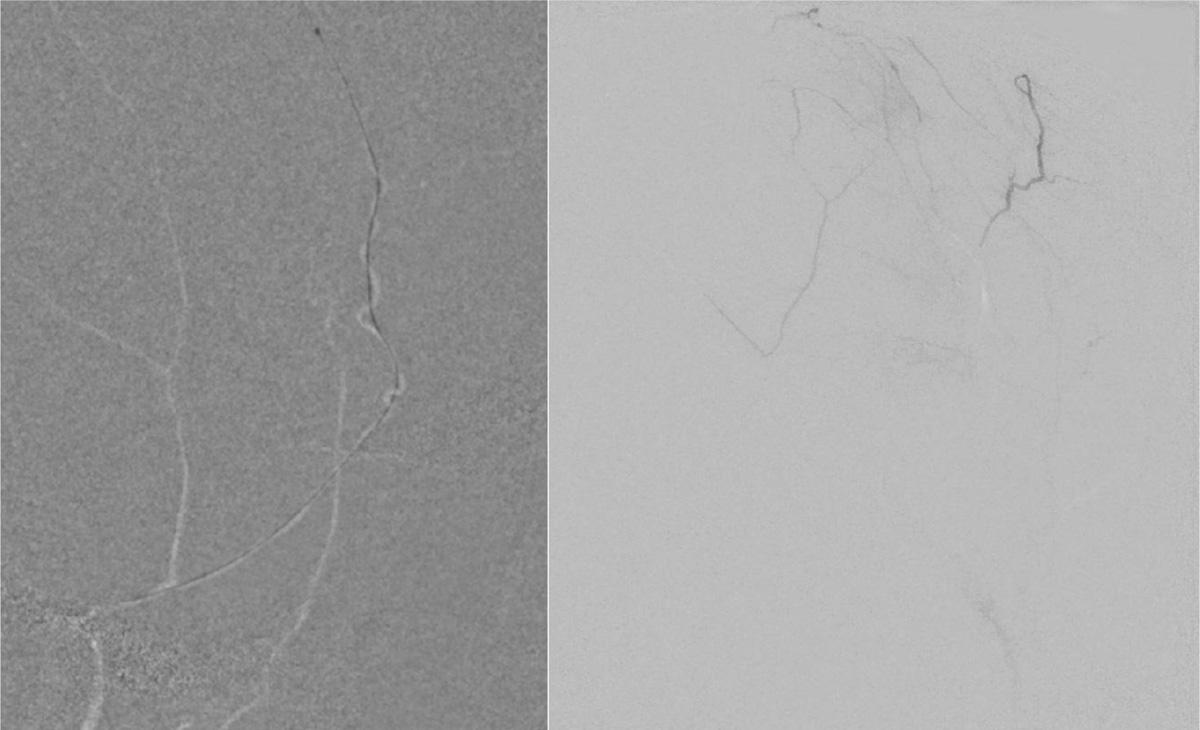 subdural-hematoma-preventing-recurrence-with-a-three-step-onyx-embolization-image5