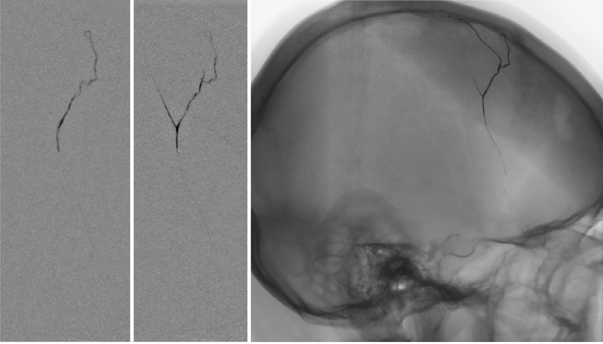subdural-hematoma-preventing-recurrence-with-a-three-step-onyx-embolization-image6