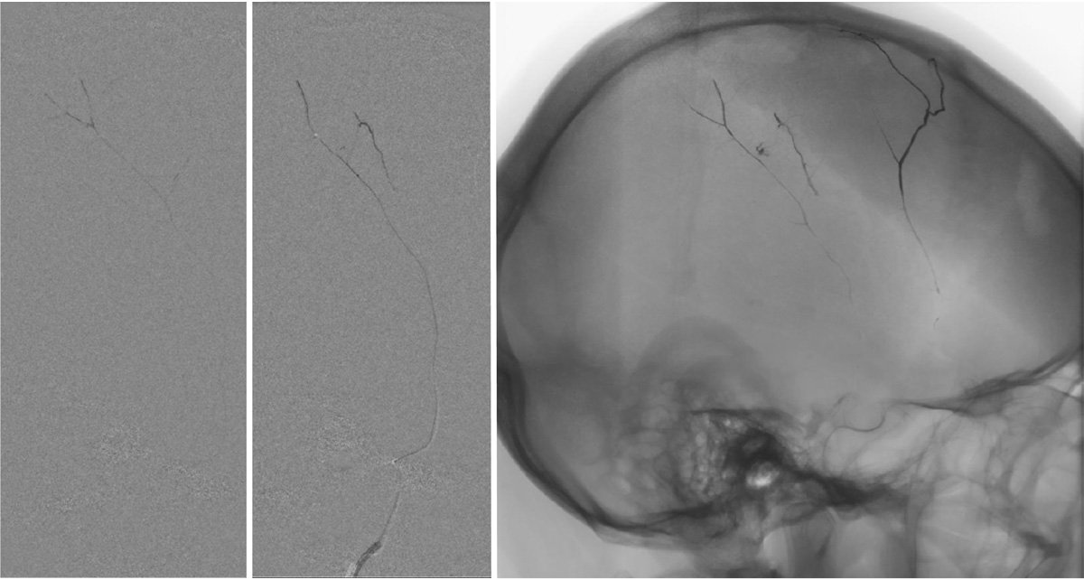 subdural-hematoma-preventing-recurrence-with-a-three-step-onyx-embolization-image8