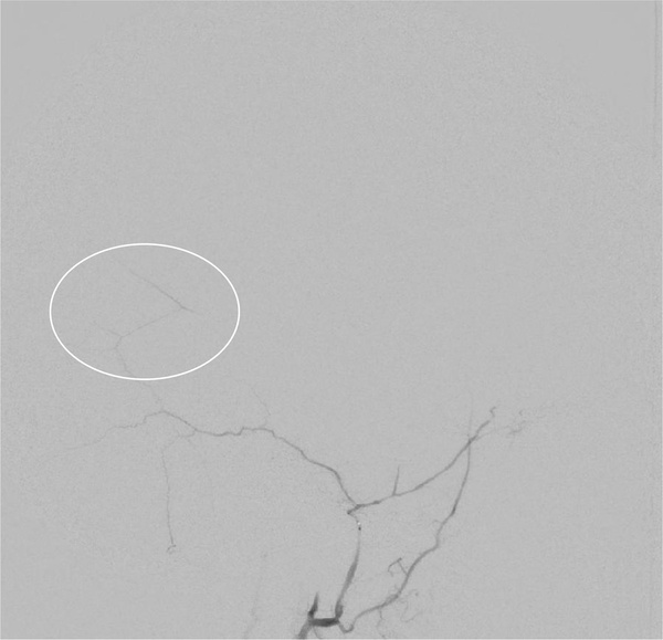 subdural-hematoma-preventing-recurrence-with-a-three-step-onyx-embolization-image9