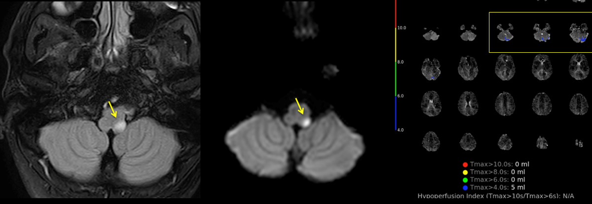 AComA-Crossover-Treatment-of-a-Complex-ICA-Tip-Aneurysm-Using-pEGASUS-HPC-stent-figure-1