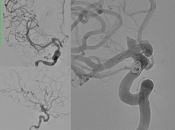 AComA-Crossover-Treatment-of-a-Complex-ICA-Tip-Aneurysm-Using-pEGASUS-HPC-stent-figure10